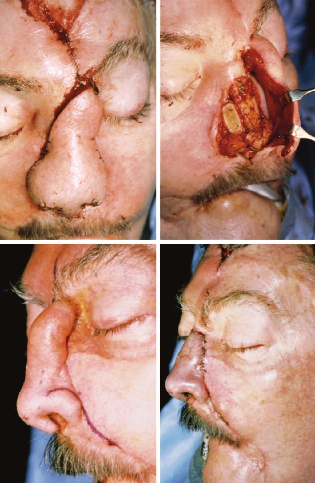 Plastic and Reconstructive Surgery September 15, 2007 Fig. 11. (Above, left) Nasal cover is supplied with a paramedian forehead flap.