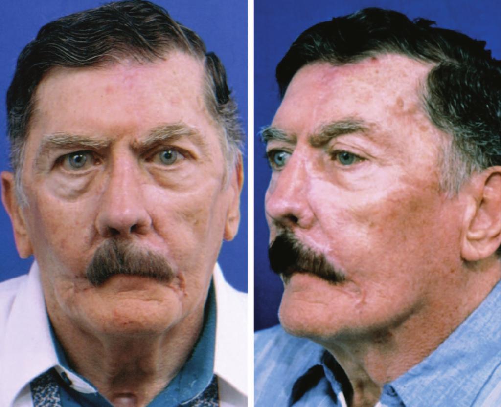 Volume 120, Number 4 Nose, Lip, and Cheek Defects PATIENT STUDY 4: MASSIVE CENTRAL FACIAL LOSS A 69-year-old man presented years after radical nasectomy, bilateral partial maxillectomy, and total