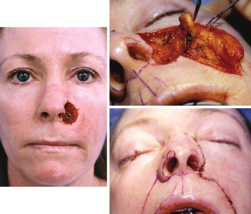 Plastic and Reconstructive Surgery September 15, 2007 Fig. 3. (Left) Defect of the left ala, lip, and cheek extending into the deep premaxillary soft tissues.