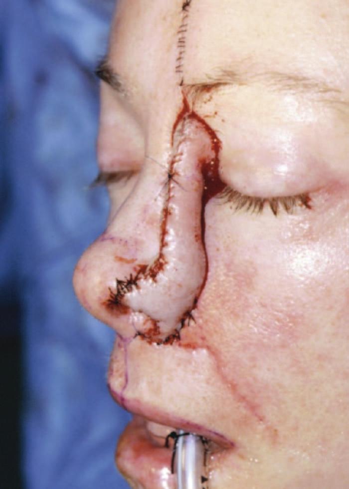Volume 120, Number 4 Nose, Lip, and Cheek Defects Fig. 4. Later, a stable platform, a subunit excision of residual normal skin and scar within the left ala subunit, is performed.