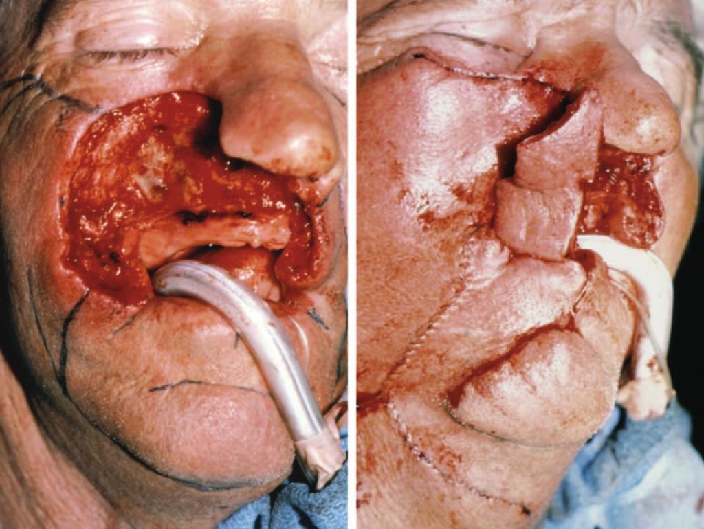 Plastic and Reconstructive Surgery September 15, 2007 Fig. 7. (Left) Defect after excision of the upper lip, columella, nasal sill, right ala, and medial cheek.