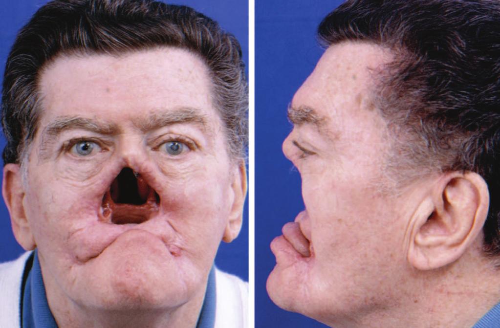 Volume 120, Number 4 Nose, Lip, and Cheek Defects Fig. 9.