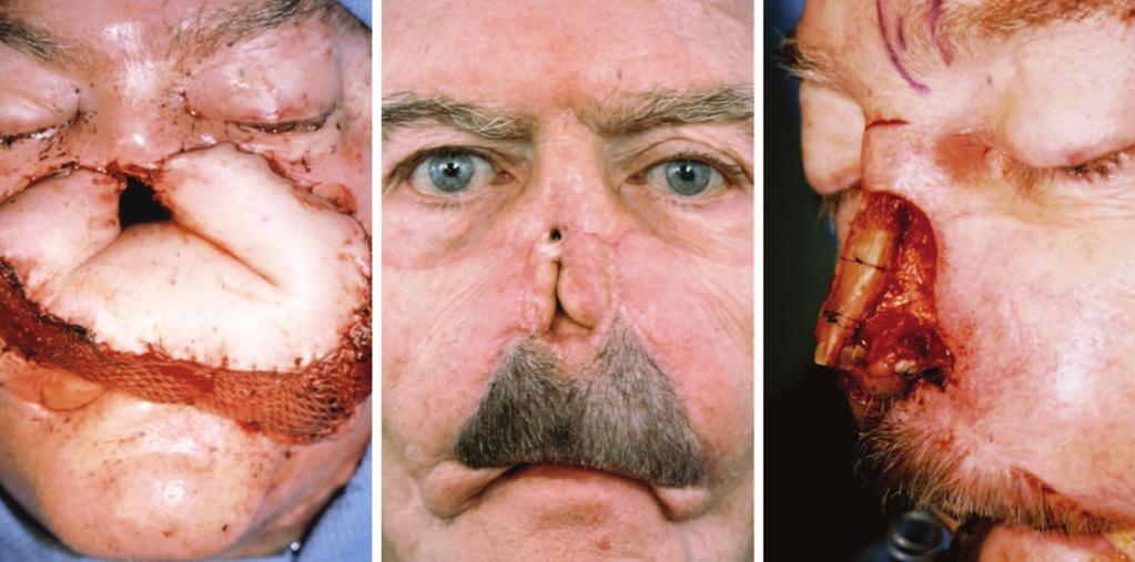 (Reproduced with permission from Menick, F. Facial reconstruction with local and distant tissue:theinterfaceofaestheticandreconstructivesurgery.plast.reconstr.surg.102:1424,1998.) Fig. 10.
