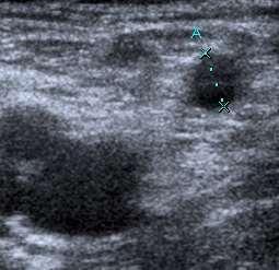 MOCA-Study Ultrasound example: