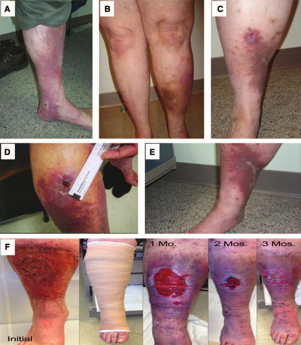 1652 Circulation October 28, 2014 Figure 4. Various degrees of postthrombotic venous ulcers. A, Healing ulcer, medial malleolus of left leg required.