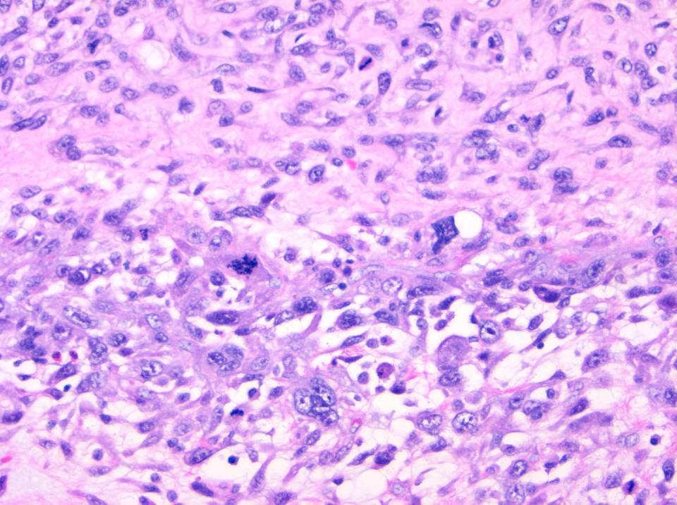 Giant cell rich osteosarcoma Pathology summary Distribution of giant cells GCT Chondroblastoma ABC GC rich osteosarcoma Uniform Heterogeneous Heterogeneous Heterogeneous Matrix Absent Fibrochondroid