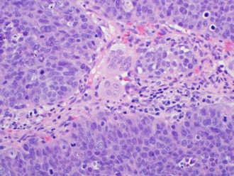 not the neoplastic population Attention to other components Mononuclear cells Matrix Giant cell tumor of bone