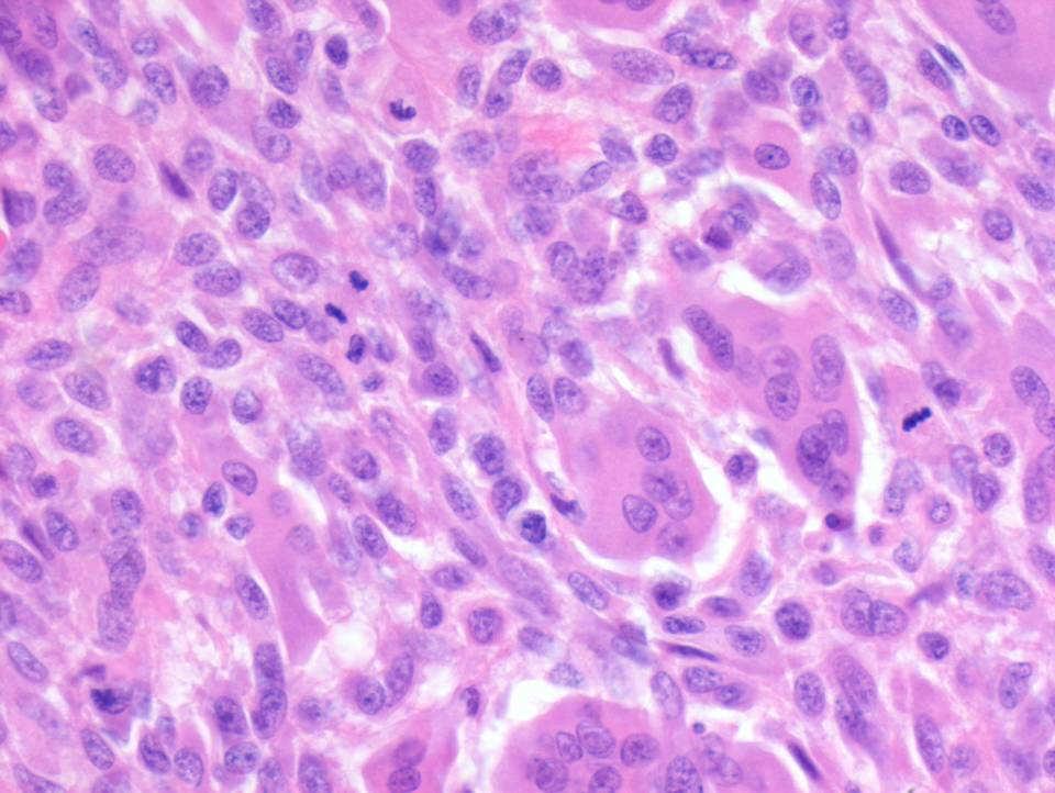 Giant cell tumor