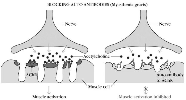 Myasthenia Gravis Blocking Autoantibodies Autoantibodies to surface receptors Blocking autoantibodies Hashimoto's thyroiditis =hypothyroid Blocking