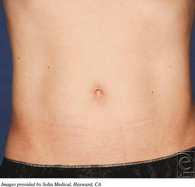 DESCRIPTION A 34-year-old healthy man presents requesting abdominal liposuction for excess abdominal fat.