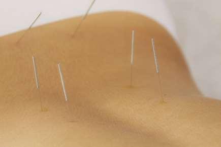 Acupuncture Premature Ovarian Failure Finding Published by HealthCMi on October 2017 Controlled studies find acupuncture effective for the treatment of premature ovarian failure (primary ovarian