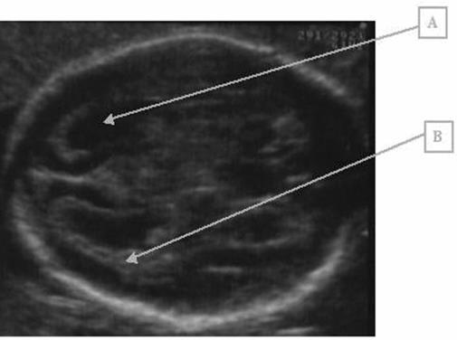Ultrasound Features Example Ventricular dilatation