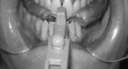 Final GG bite registration Starting mandibular treatment position is 60% of maximum protrusion Minimum of 7mm protrusion