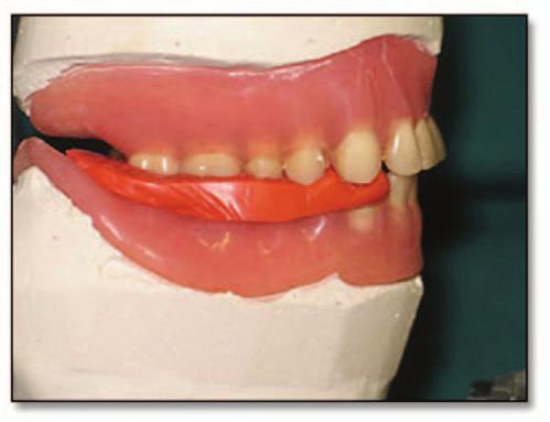 The prevalence of uneven occlusal contacts after complete denture placement has not been investigated.