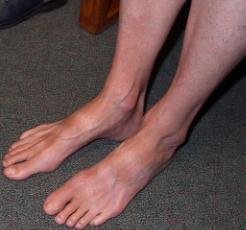 deformities Feet may be flat Decreased