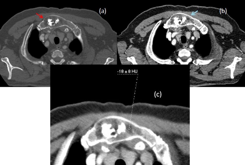 Intralesional calcifications were also noted as signal void, curvilinear areas in line with the CT findings (Fig. 3 on page 4).