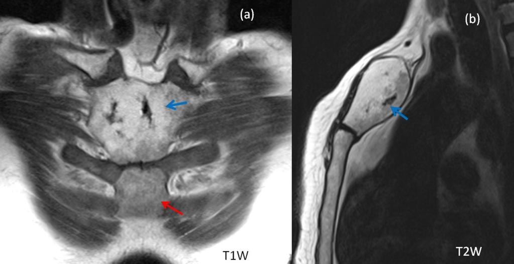 Fig. 3: Coronal T1- weighted (a) and sagittal T2 -weighted (b) images of manubrium sterni confirm the expansile changes and show relatively high signal