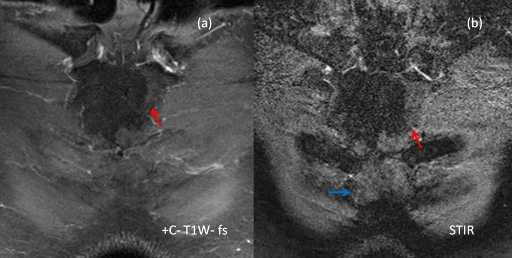 The calcifications appear as signal void areas (blue arrows) on both T1 and T2- weighted images Fig.