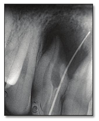 Clinically an anatomical malformation in the crown of the upper right lateral incisor was detected in the form of an abnormal bulbous contour of the tooth in the palatal region above the cingulum