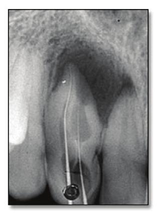 A Leubke-Oschenbien surgical flap was raised followed by an osteotomy and curettage of the periapical lesion.