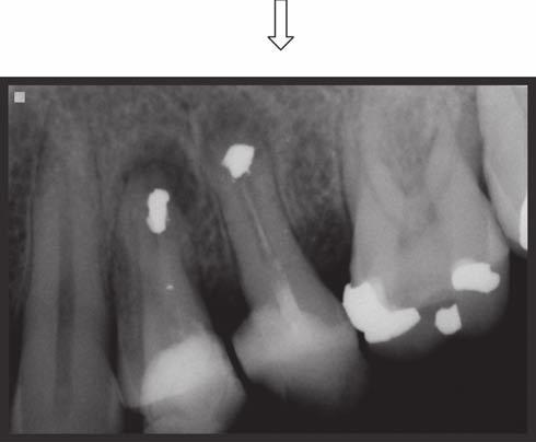 by the clinician or eliminated by intra-canal medicaments, as they are situated away from the apex 2.