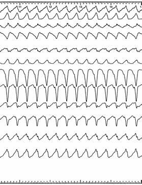 Mahaim Tachycardia Figure 1. Twelve-lead ECGs during sinus rhythm (left panel) and tachycardia (right panel). I, II, II, avr, avl, avf, V 1 to V 6 surface ECG leads. Figure 2.