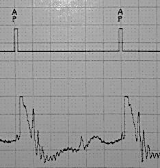 Via 12-lead or other surface ECG, measure the QRS width and V sense time during high output pacing (typically start at 5V @ 1 ms). Run a threshold test, decrementing voltage over time.