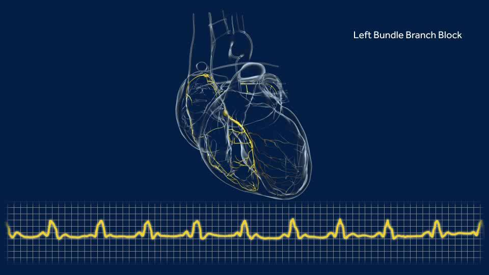 OVERVIEW OF HIS-BUNDLE PACING CONDUCTION SYSTEM REVIEW Click play on the video below to view an animation of the Normal