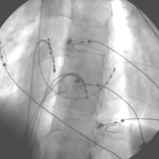 4mm irrigated tip catheter was placed on His observing retrograde AP potential and first atrial activation on ABL_d.