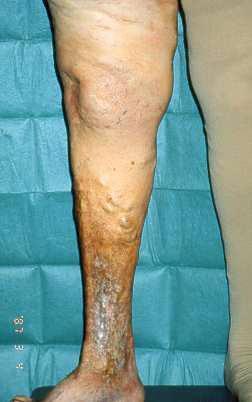 Our clinical experience MCS, except for large complicated varicose veins/c4-6, is