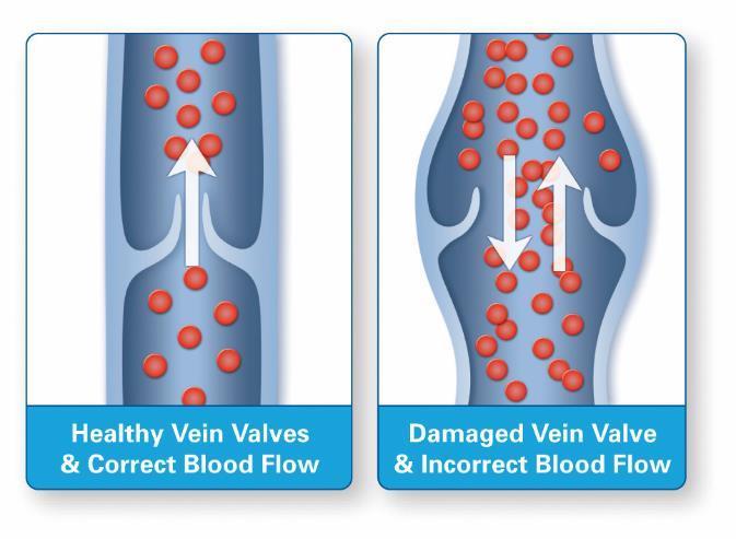 Etiology & Pathophysiology Healthy veins, with competent vein valves, keep blood moving in one direction back to