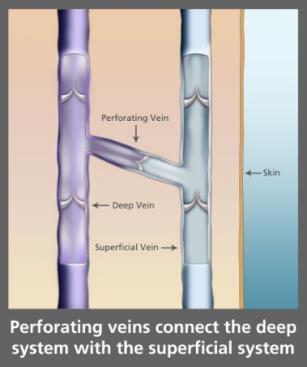 Anatomy: Perforators Perforator valves maintain one-way flow from superficial to deep veins Perforator valve failure causes: Higher venous pressure and GSV/branch dilation