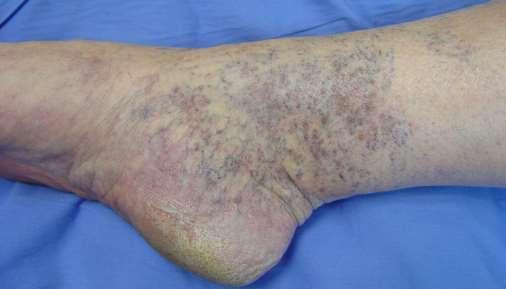 Clinical CEAP 1 C1: Telangiectasia Always Primary and Superficial Work-up: Focused