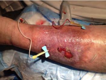 Perforator Ablation Against selective treatment of incompetent perforating veins in patients