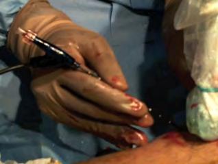 subfascial endoscopic perforating vein surgery, ultrasonographically guided sclerotherapy, or
