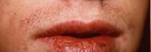 Skin on the lips is very thin and vulnerable to the sun s UV rays 6 10% of cases