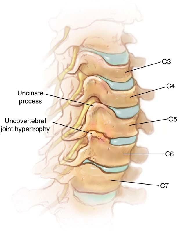 Figure 1.6. The C3 C7 vertebrae have uncinate processes which are upward projections of the lateral edges of the vertebral body on each side.
