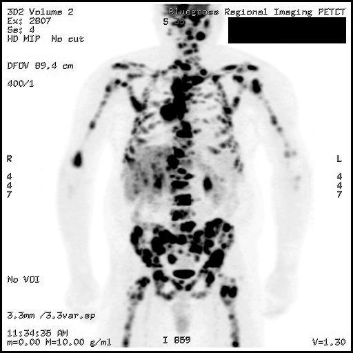Diagnosis: PET-CT Scan www.