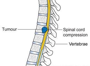 of vertebral collapse or instability by metastatic spread or direct
