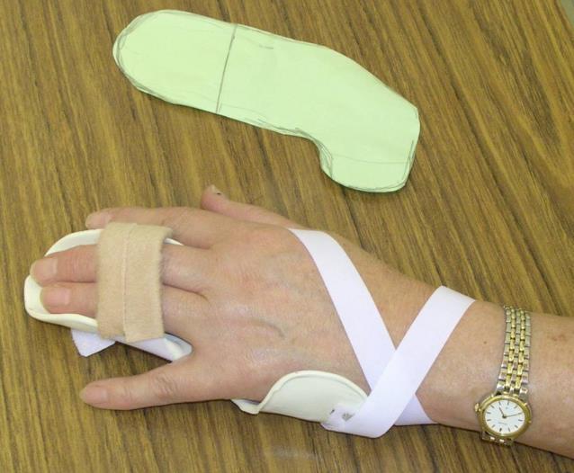 immobilise the joints that they cross (beware of prolonged immobilisation leading to