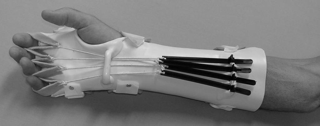 3. Static progressive splints: 5 used as an exercise splint this is NOT a functional splint very useful to improve passive range of movement in an isolated, stiff joint, where other treatment