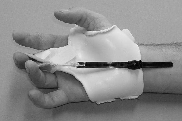 Techniques for static progressive components Splint base likely to need to immobilise normal