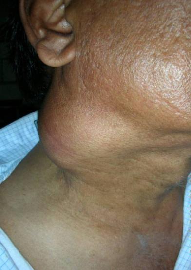 61/M Tobacco chewer Presented with Right sided neck mass 2.5 months.