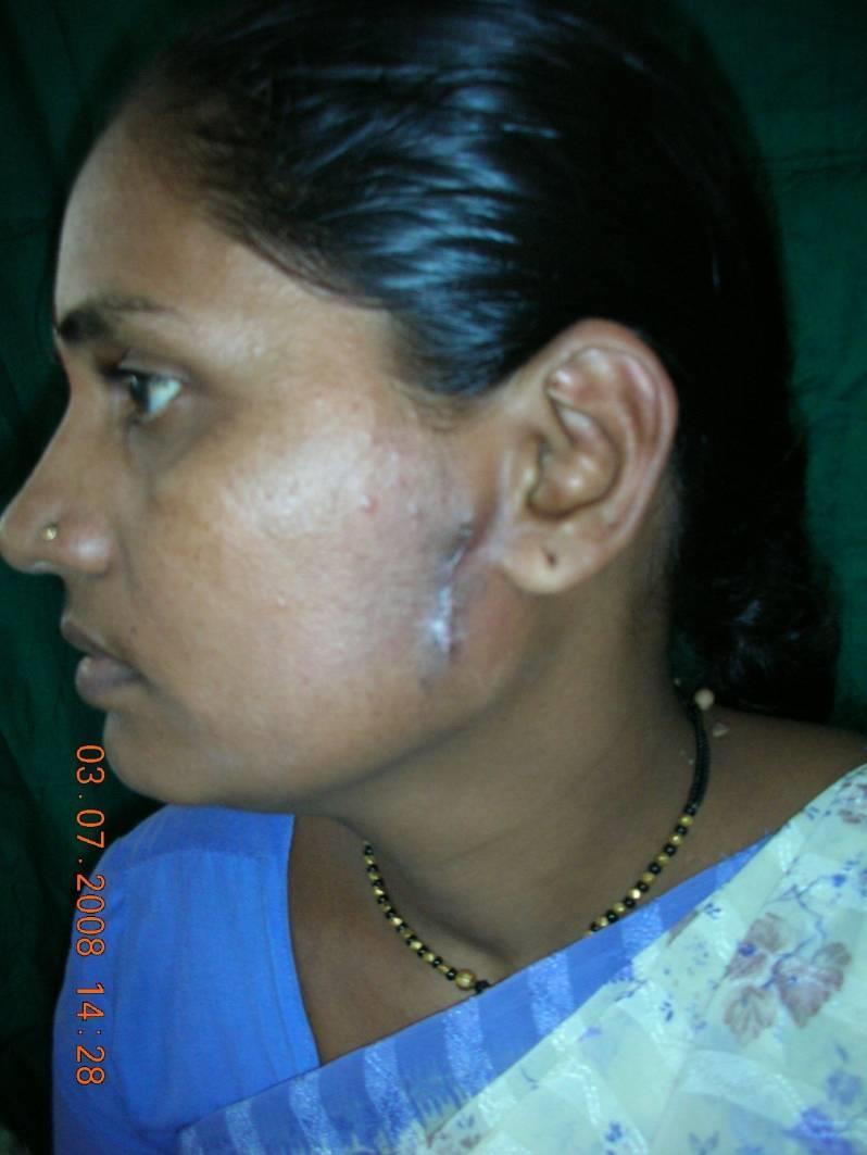 38/F Left Parotid lesion operated 1 month back Details of surgery not available.