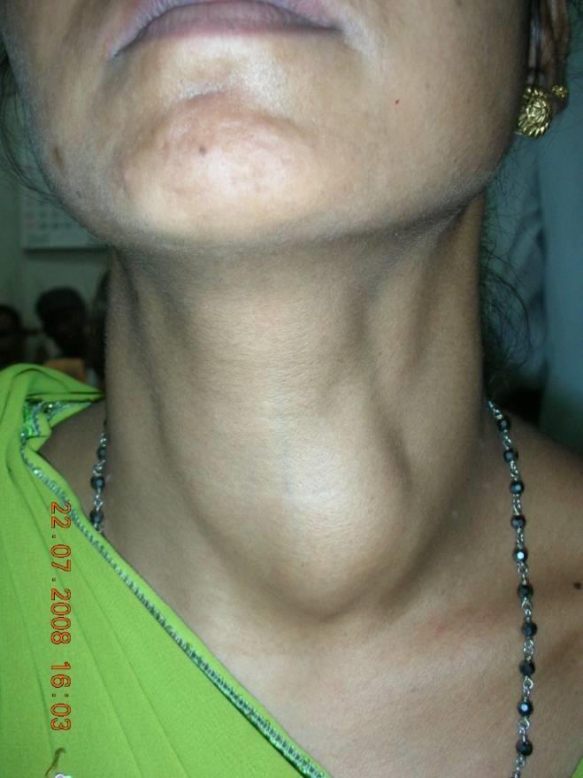 45/F Presented with Left Thyroid swelling since 4