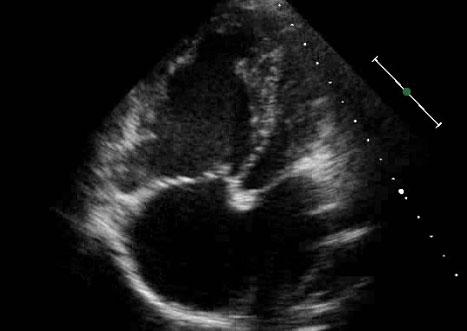 RV RA Figure 1. Apical four-chamber view on echocardiogram in a patient with Group 1 pulmonary hypertension.