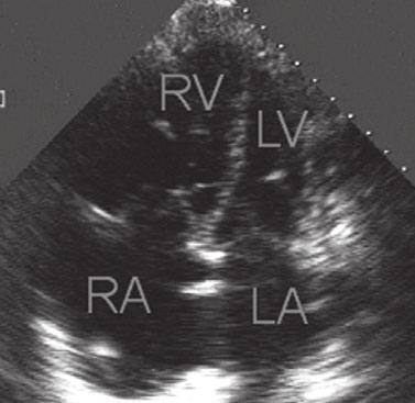 Figure 3. Apical four-chamber view on echocardiogram in a patient with Group 2 pulmonary hypertension.