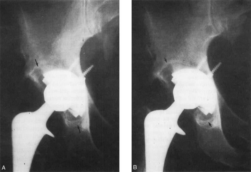 Number 369 December, 1999 Fixation, Wear, and Pelvic Osteolysis 159 Fig 2A-B.