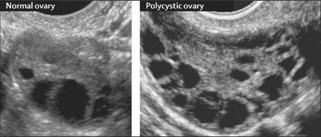 Polycystic ovaries on US Ovarian volume >10cc in absence of dominant follicle >12 follicles 2-9mm in a single ovary The Lancet 2007 370, 685-697DOI: (10.