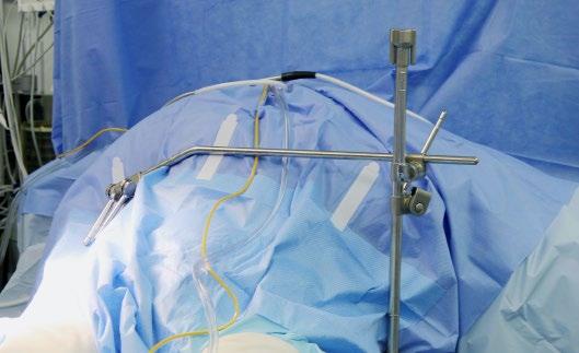 Step 1: Attach Elite to Bed Place Elite Rail Clamp onto the table rail over the sterile drape on the side opposite of the surgeon, and at the axilla